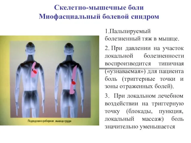 Скелетно-мышечные боли Миофасциальный болевой синдром 1.Пальпируемый болезненный тяж в мышце. 2.