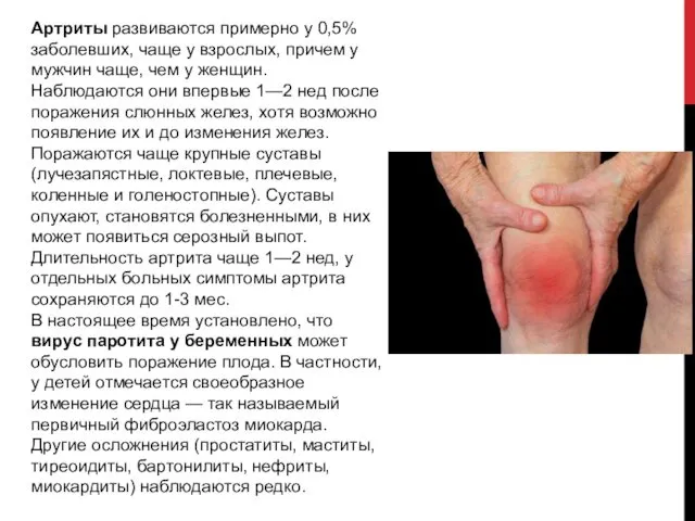 Артриты развиваются примерно у 0,5% заболевших, чаще у взрослых, причем у