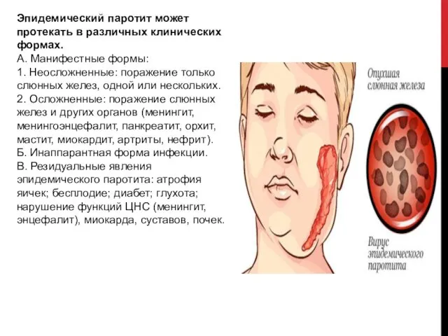 Эпидемический паротит может протекать в различных клинических формах. А. Манифестные формы: