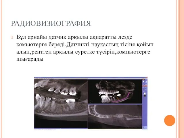 РАДИОВИЗИОГРАФИЯ Бұл арнайы датчик арқылы ақпаратты лезде комьютерге береді.Датчикті науқастың тісіне