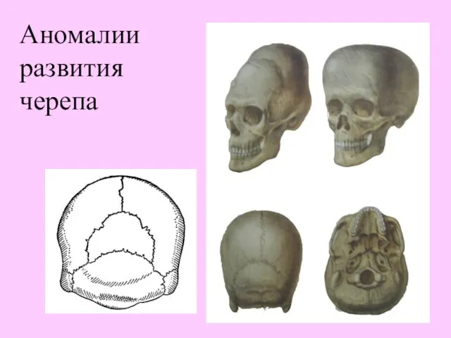 Аномалии развития черепа