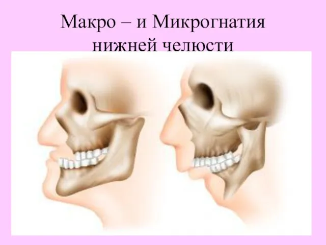 Макро – и Микрогнатия нижней челюсти