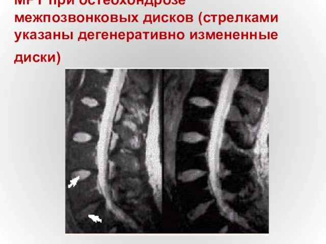 МРТ при остеохондрозе межпозвонковых дисков (стрелками указаны дегенеративно измененные диски)