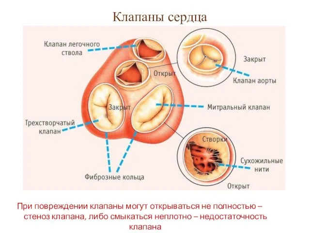 Клапаны сердца При повреждении клапаны могут открываться не полностью – стеноз