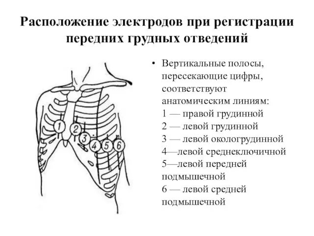 Расположение электродов при регистрации передних грудных отведений Вертикальные полосы, пересекающие цифры,