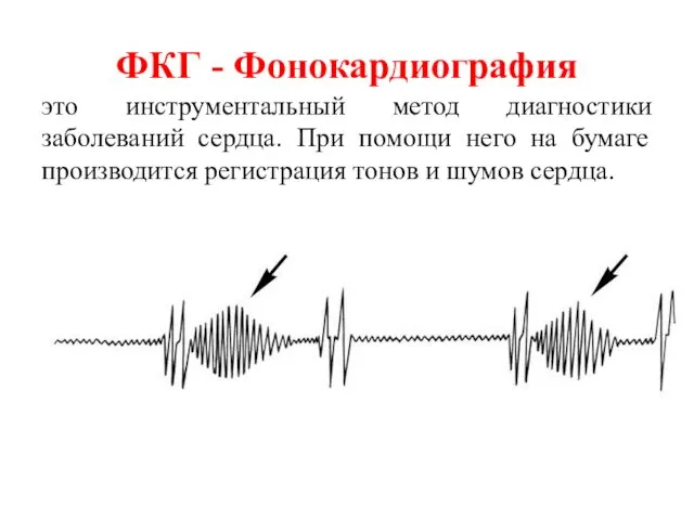 ФКГ - Фонокардиография это инструментальный метод диагностики заболеваний сердца. При помощи