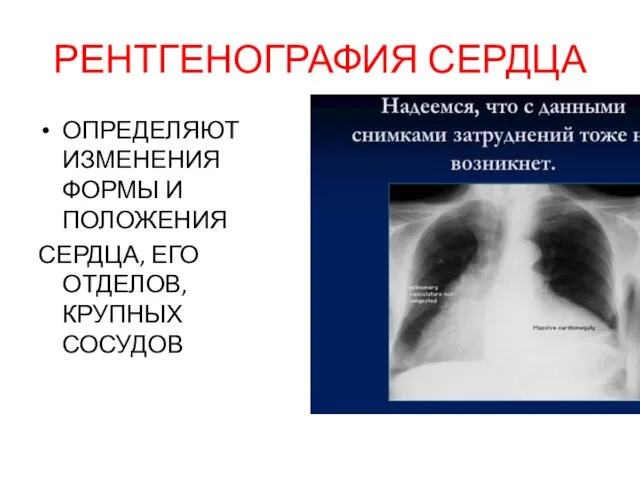 РЕНТГЕНОГРАФИЯ СЕРДЦА ОПРЕДЕЛЯЮТ ИЗМЕНЕНИЯ ФОРМЫ И ПОЛОЖЕНИЯ СЕРДЦА, ЕГО ОТДЕЛОВ, КРУПНЫХ СОСУДОВ