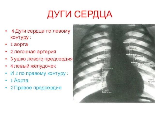 ДУГИ СЕРДЦА 4 Дуги сердца по левому контуру : 1 аорта