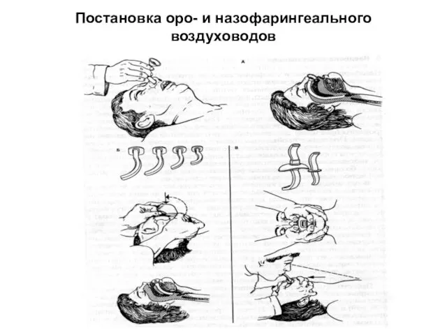 Постановка оро- и назофарингеального воздуховодов