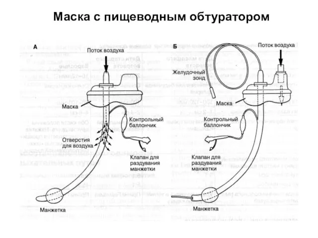 Маска с пищеводным обтуратором