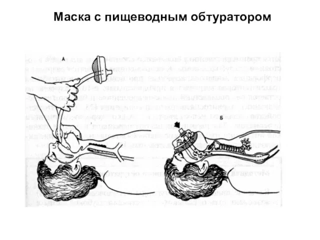 Маска с пищеводным обтуратором