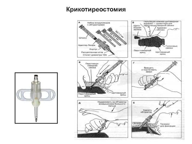 Крикотиреостомия