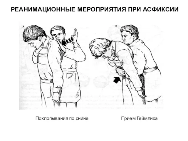 Похлопывания по снине Прием Геймлиха РЕАНИМАЦИОННЫЕ МЕРОПРИЯТИЯ ПРИ АСФИКСИИ