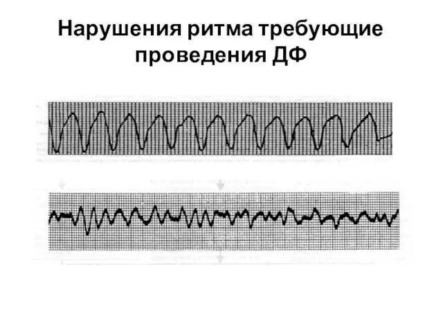 Нарушения ритма требующие проведения ДФ