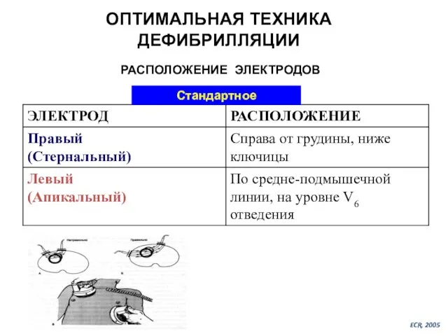 РАСПОЛОЖЕНИЕ ЭЛЕКТРОДОВ Стандартное ECR, 2005 ОПТИМАЛЬНАЯ ТЕХНИКА ДЕФИБРИЛЛЯЦИИ