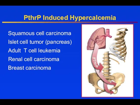 PthrP Induced Hypercalcemia Squamous cell carcinoma Islet cell tumor (pancreas) Adult