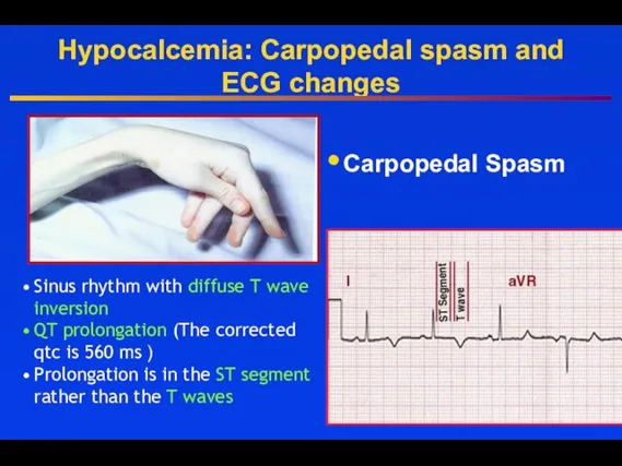 Hypocalcemia: Carpopedal spasm and ECG changes Carpopedal Spasm Sinus rhythm with