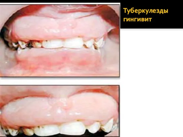 Туберкулезды гингивит