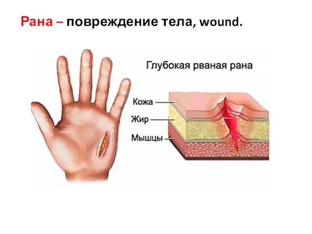 Рана – повреждение тела, wound.