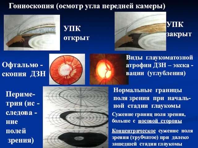 Гониоскопия (осмотр угла передней камеры) УПК открыт УПК закрыт Офтальмо -