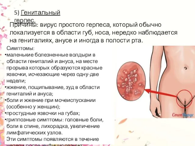 5) Генитальный герпес. Причины: вирус простого герпеса, который обычно локализуется в