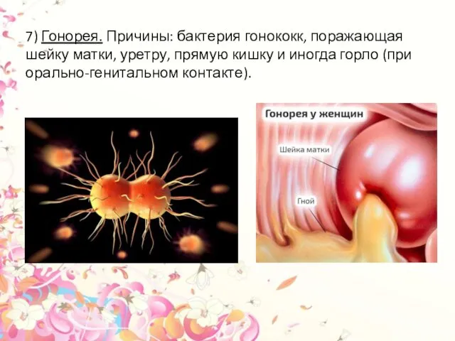 7) Гонорея. Причины: бактерия гонококк, поражающая шейку матки, уретру, прямую кишку