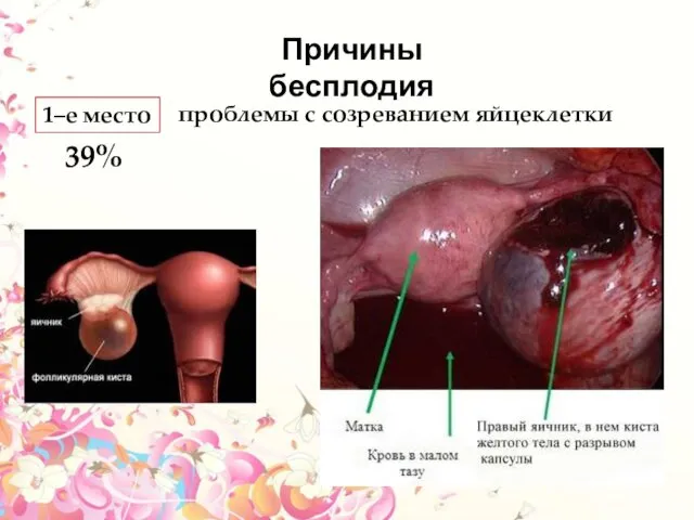 Причины бесплодия 1–е место проблемы с созреванием яйцеклетки 39%