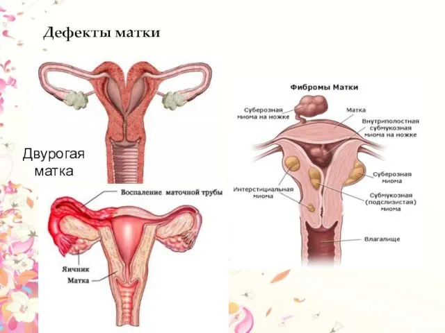 Дефекты матки Двурогая матка