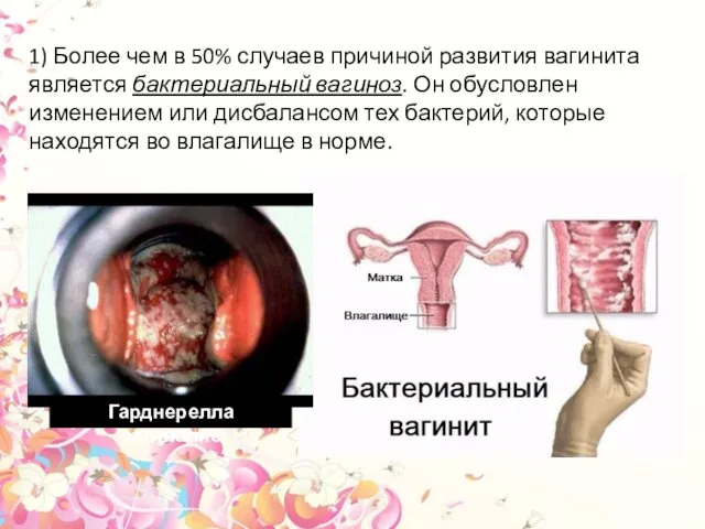 1) Более чем в 50% случаев причиной развития вагинита является бактериальный