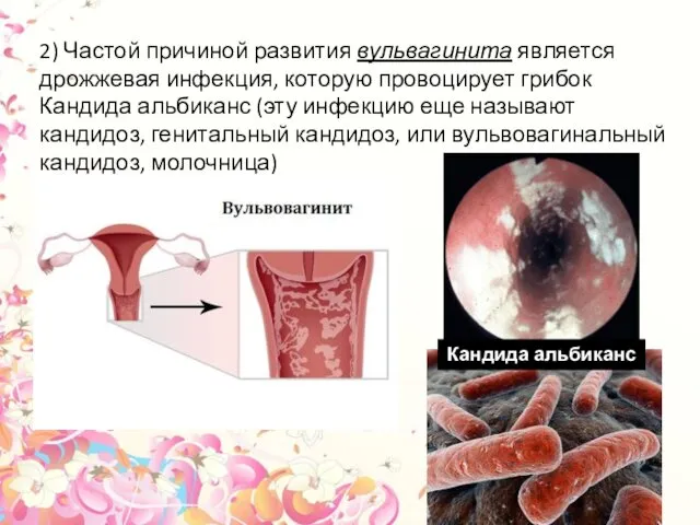 2) Частой причиной развития вульвагинита является дрожжевая инфекция, которую провоцирует грибок