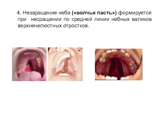 4. Незаращение неба («волчья пасть») формируется при несращении по средней линии небных валиков верхнечелюстных отростков.