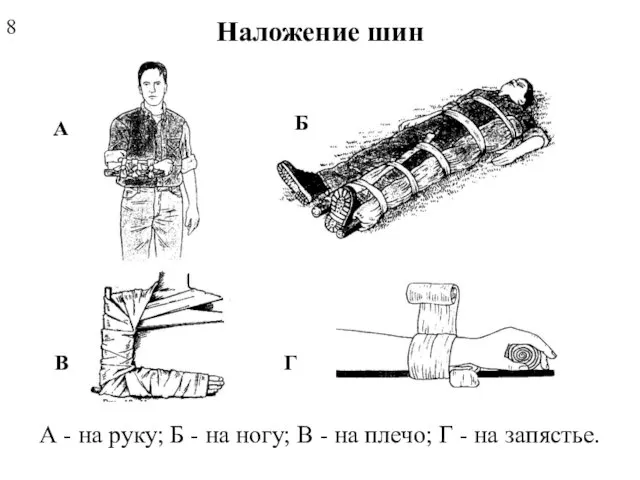 Наложение шин А Б В Г А - на руку; Б