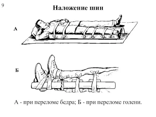 Наложение шин А А Б А - при переломе бедра; Б - при переломе голени. 9