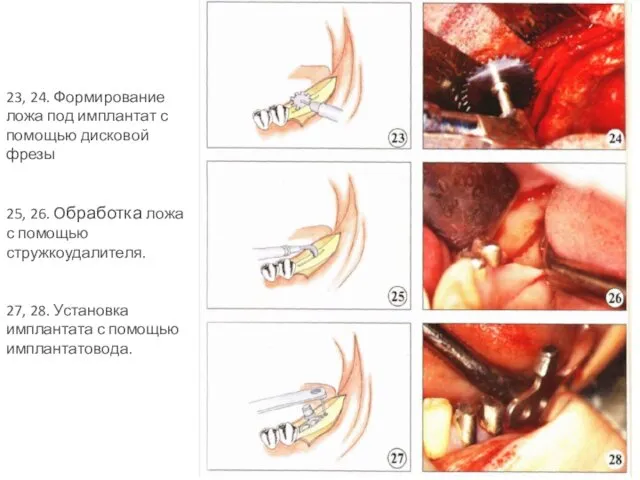 23, 24. Формирование ложа под имплантат с помощью дисковой фрезы 25,
