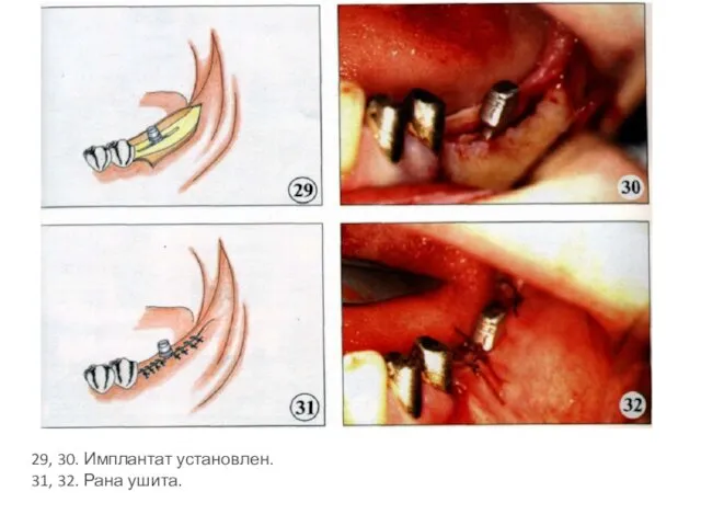 29, 30. Имплантат установлен. 31, 32. Рана ушита.