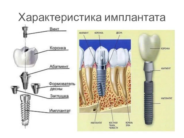 Характеристика имплантата