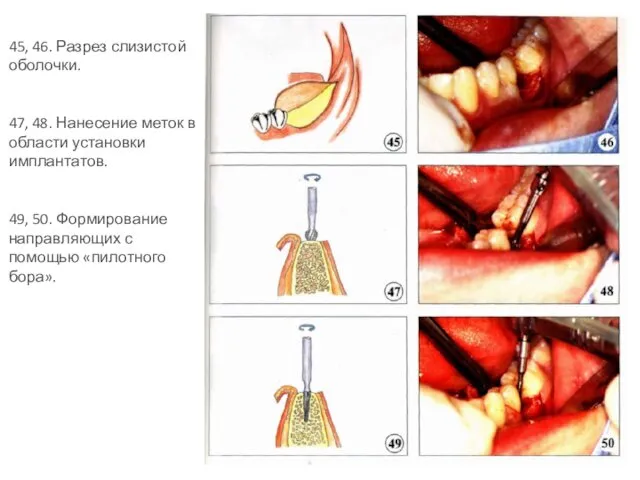 45, 46. Разрез слизистой оболочки. 47, 48. Нанесение меток в области