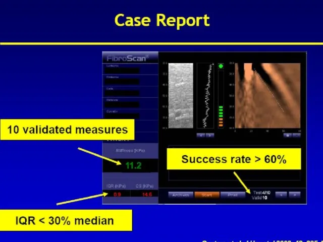 Fibrotest Equivalent METAVIR 0.75-1.00 F4 0.73-0.74 F3-F4 0.59-0.72 F3 0.49-0.58 F2