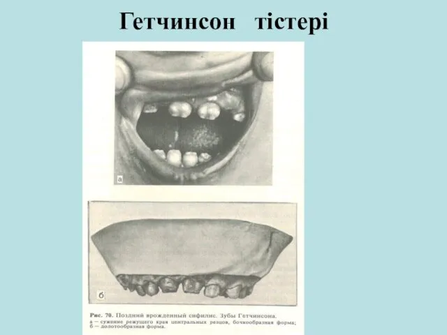 Гетчинсон тістері