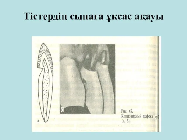 Тістердің сынаға ұқсас ақауы