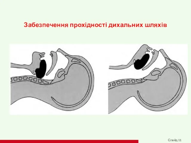 Забезпечення прохідності дихальних шляхів Слайд 11