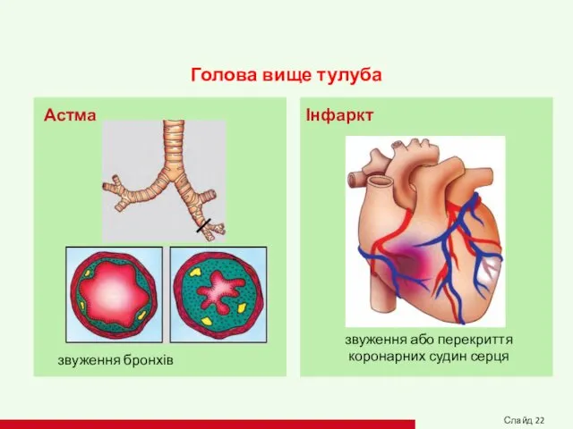 Голова вище тулуба звуження або перекриття коронарних судин серця звуження бронхів Астма Інфаркт Слайд 22