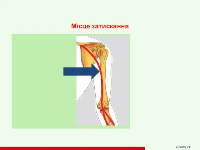 Місце затискання Слайд 23