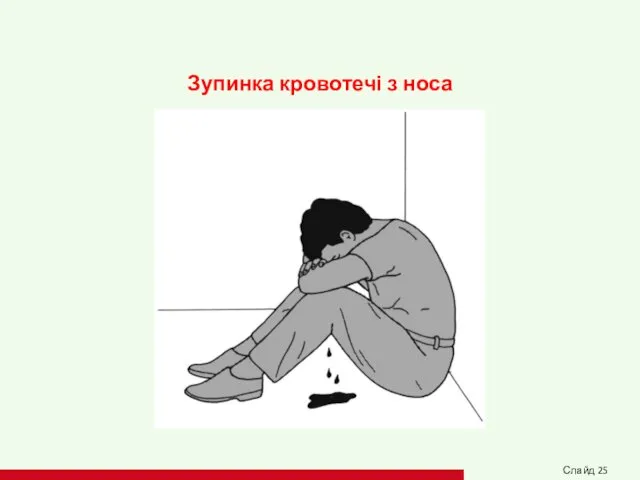 Зупинка кровотечі з носа Слайд 25