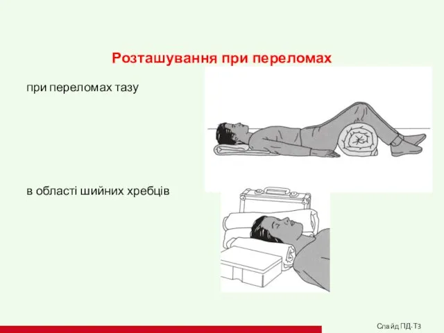 Розташування при переломах при переломах тазу в області шийних хребців Слайд ПД-Т3