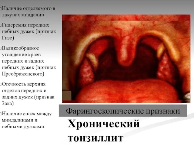 Хронический тонзиллит Наличие отделяемого в лакунах миндалин Гиперемия передних небных дужек