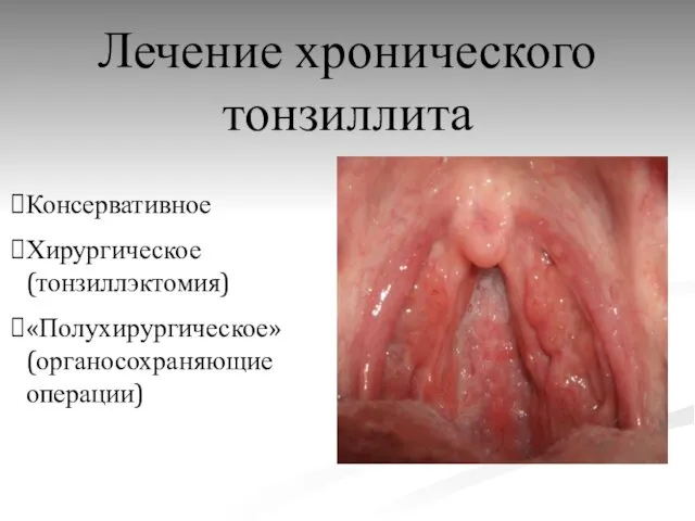 Лечение хронического тонзиллита Консервативное Хирургическое (тонзиллэктомия) «Полухирургическое» (органосохраняющие операции)