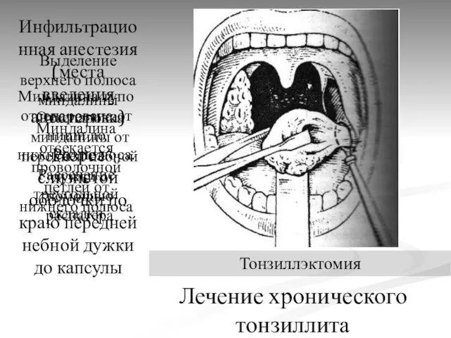 Лечение хронического тонзиллита Тонзиллэктомия Инфильтрационная анестезия (места введения анестетика) Разрез слизистой