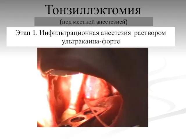 Тонзиллэктомия Этап 1. Инфильтрационная анестезия раствором ультракаина-форте (под местной анестезией)