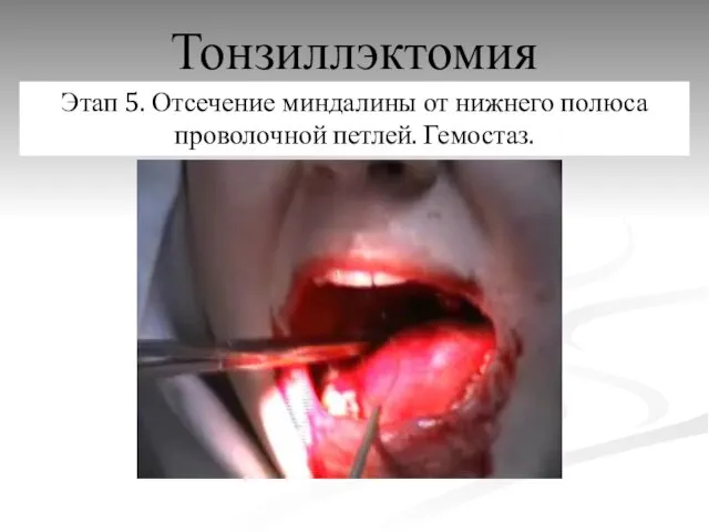 Тонзиллэктомия Этап 5. Отсечение миндалины от нижнего полюса проволочной петлей. Гемостаз.